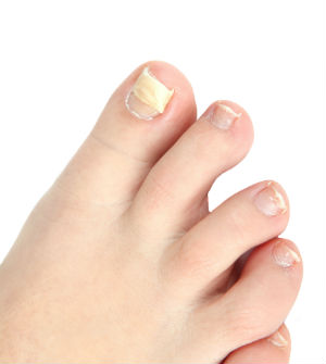 12-facts-about-nail-fungus
