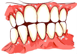 Unhealthy gum tissue with periodontitis
