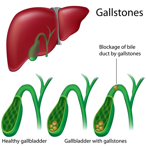 Gallstones are small clumps that form in your gallbladder that can be asymptomatic or cause tremendous pain in the upper abdomen.